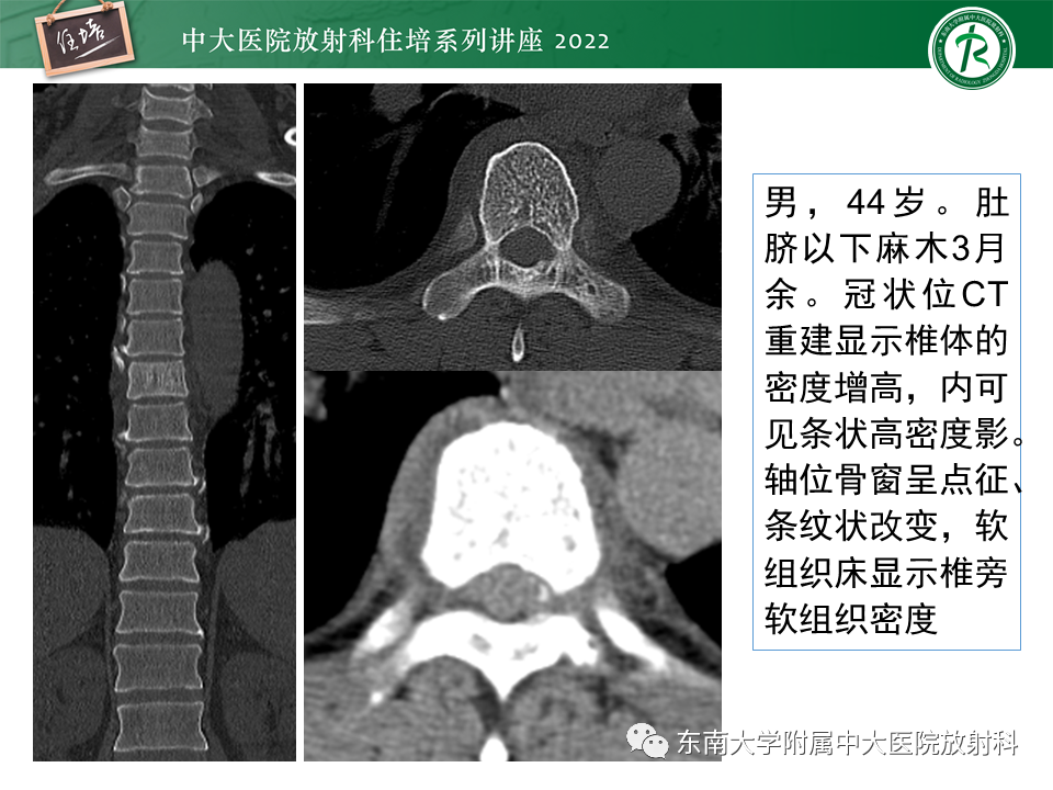影像PPT - 【PPT】常见椎体孤立性肿瘤的诊断思路-2
