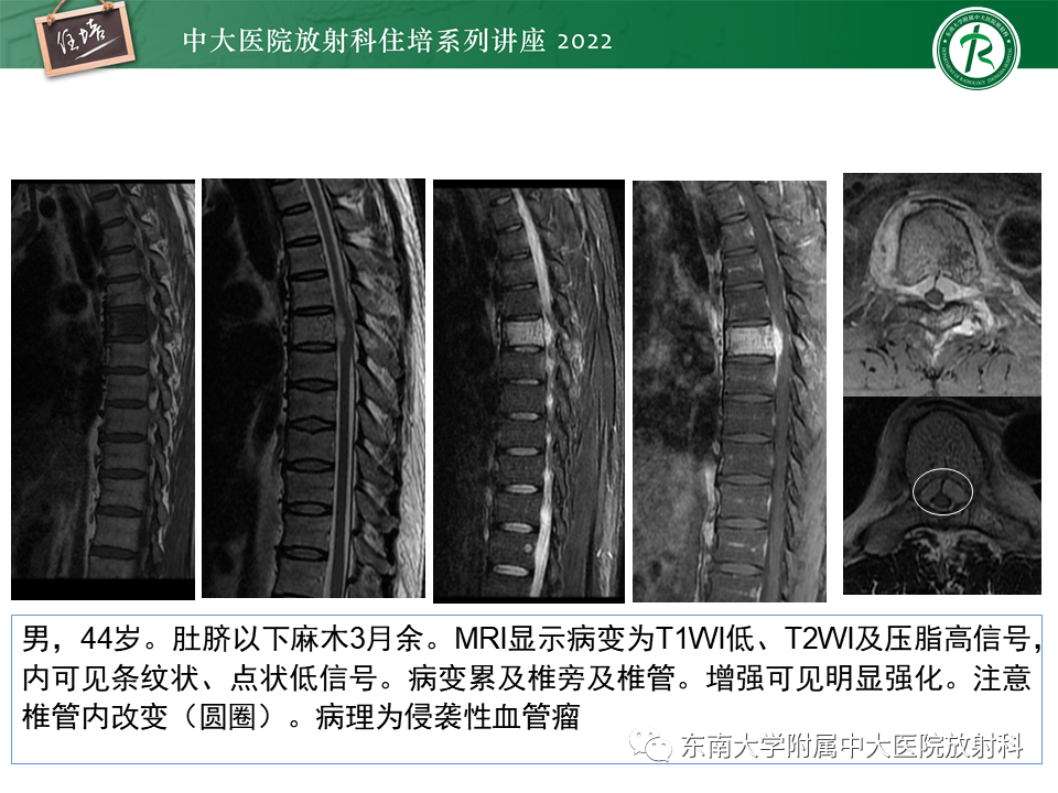影像PPT - 【PPT】常见椎体孤立性肿瘤的诊断思路-3