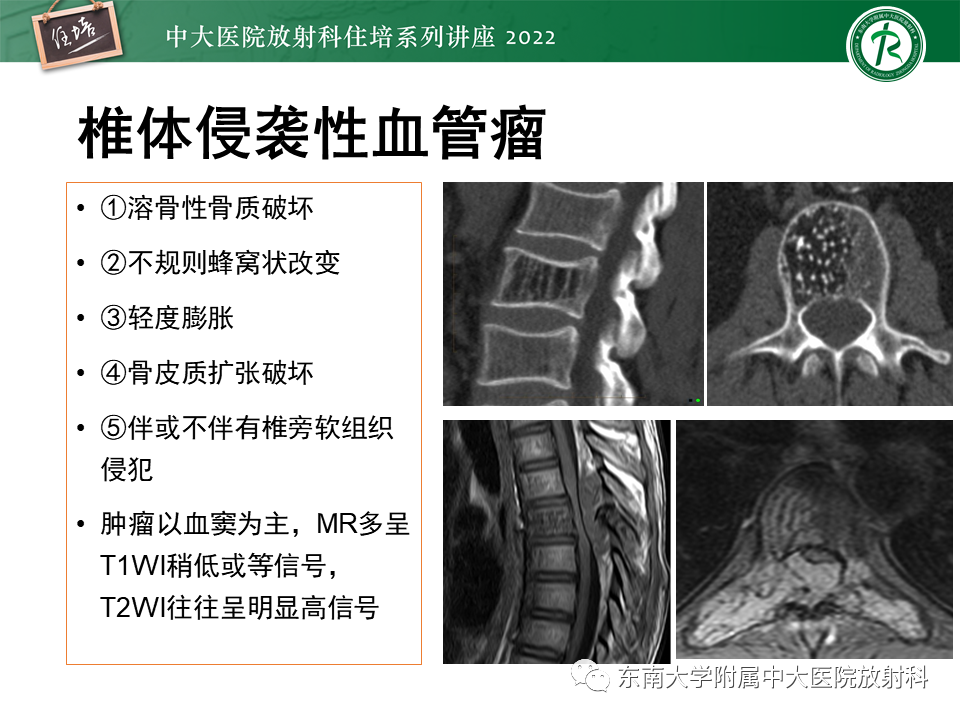 影像PPT - 【PPT】常见椎体孤立性肿瘤的诊断思路-5