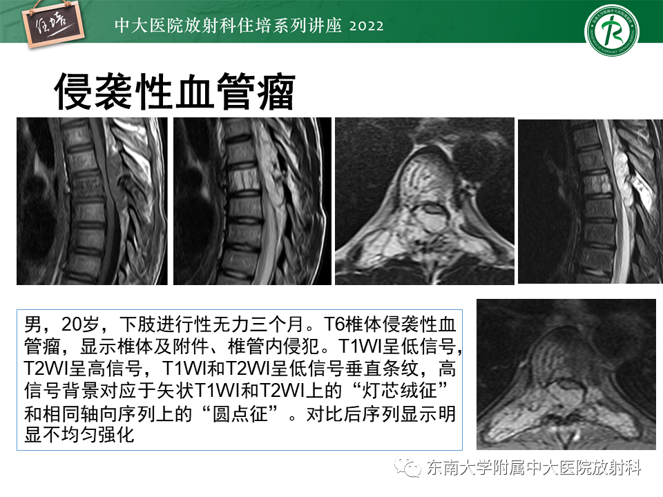 影像PPT - 【PPT】常见椎体孤立性肿瘤的诊断思路-7