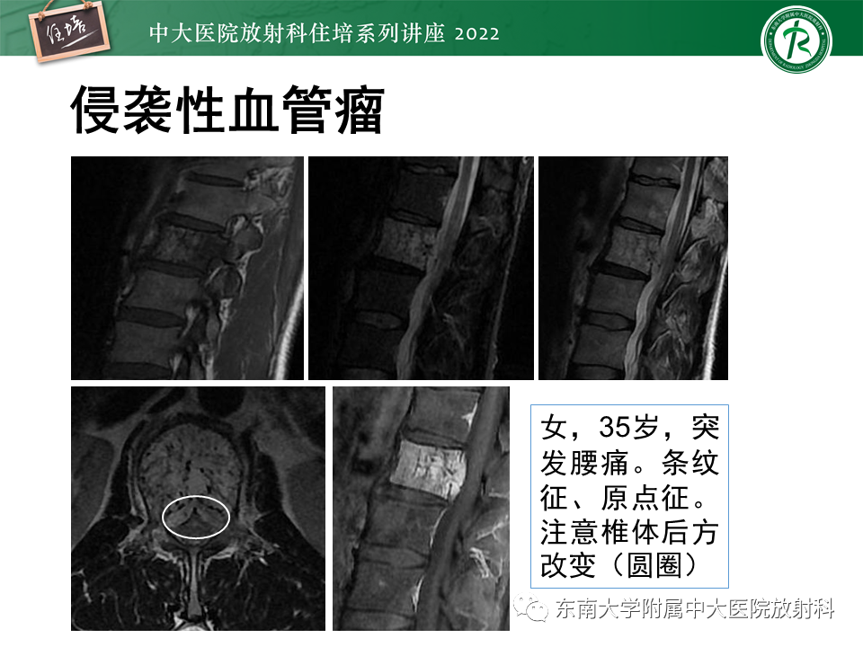 影像PPT - 【PPT】常见椎体孤立性肿瘤的诊断思路-6