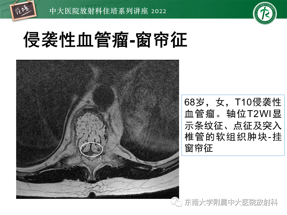影像PPT - 【PPT】常见椎体孤立性肿瘤的诊断思路-9