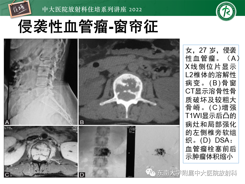 影像PPT - 【PPT】常见椎体孤立性肿瘤的诊断思路-10