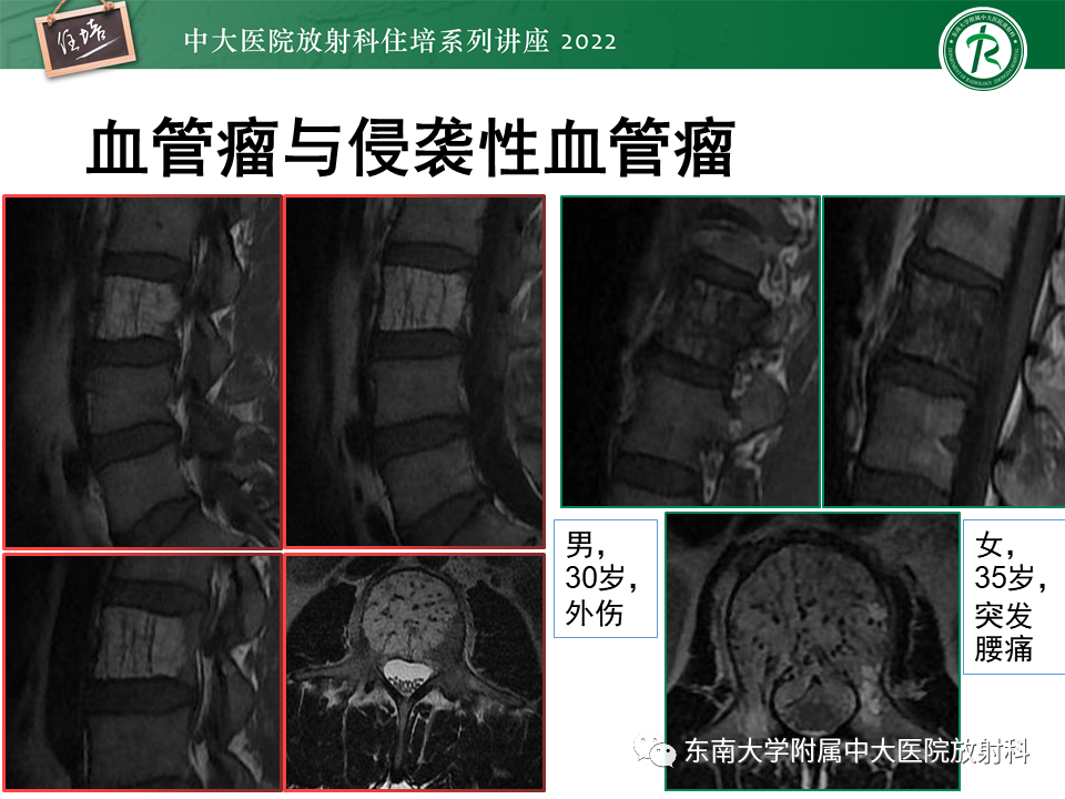 影像PPT - 【PPT】常见椎体孤立性肿瘤的诊断思路-11
