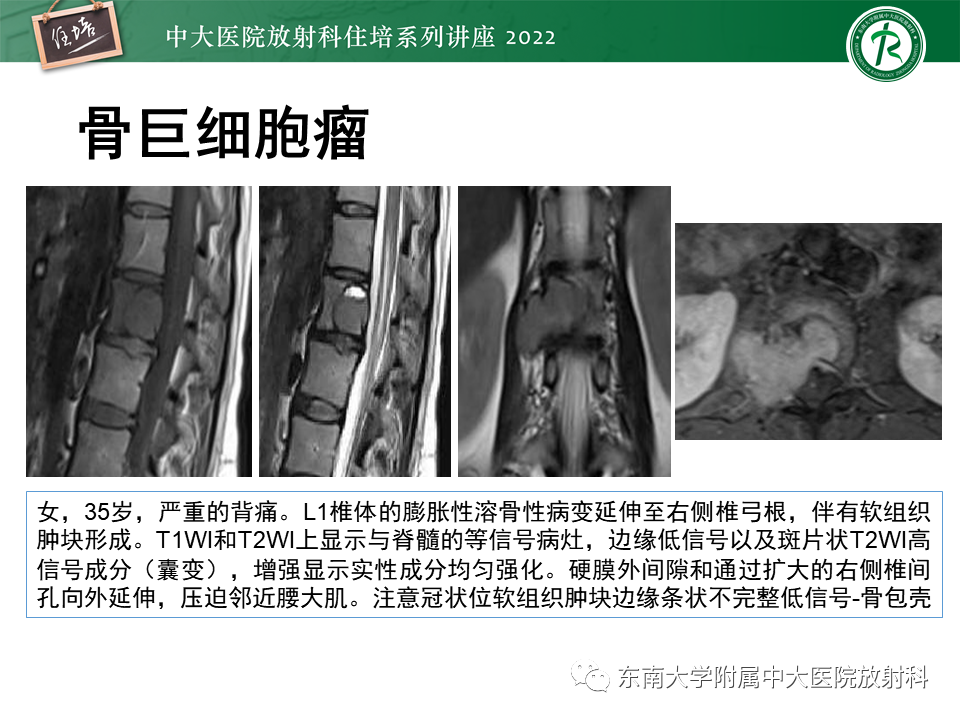影像PPT - 【PPT】常见椎体孤立性肿瘤的诊断思路-16