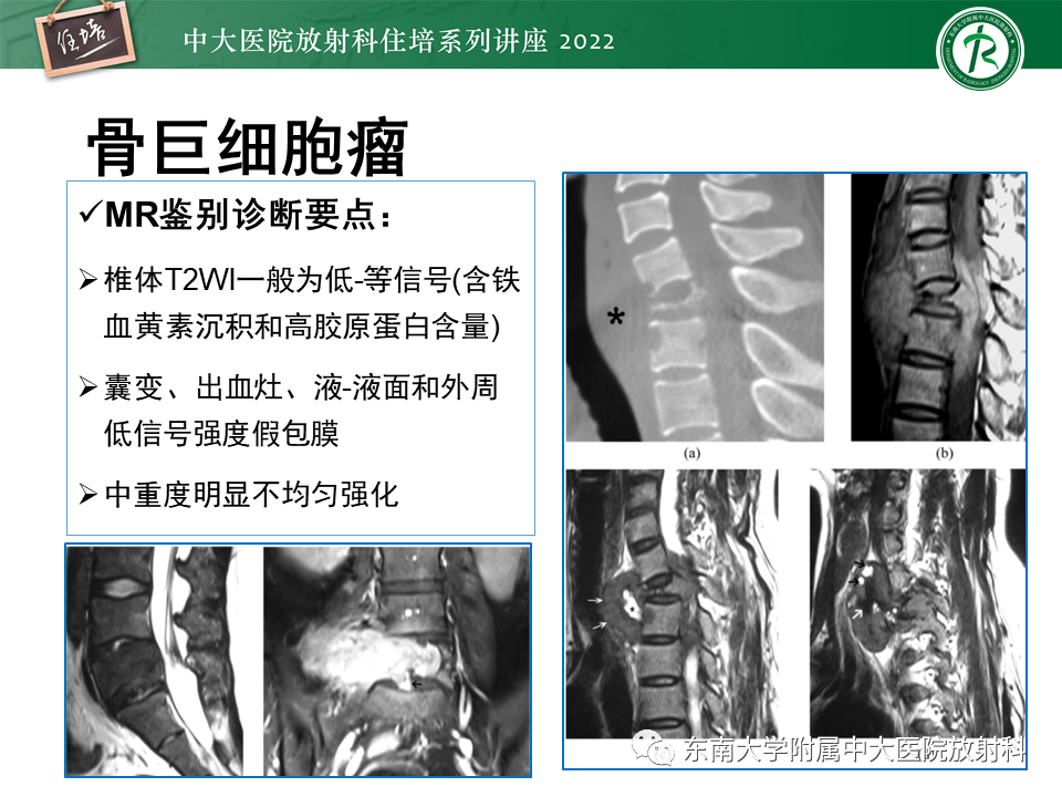 影像PPT - 【PPT】常见椎体孤立性肿瘤的诊断思路-15