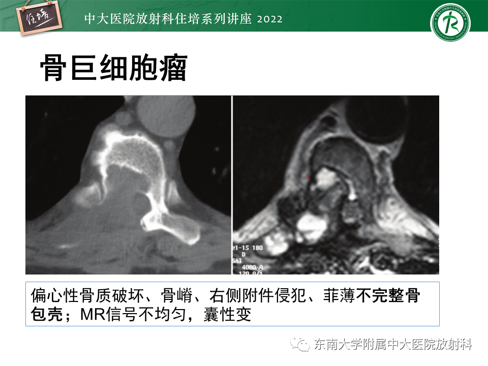 影像PPT - 【PPT】常见椎体孤立性肿瘤的诊断思路-18