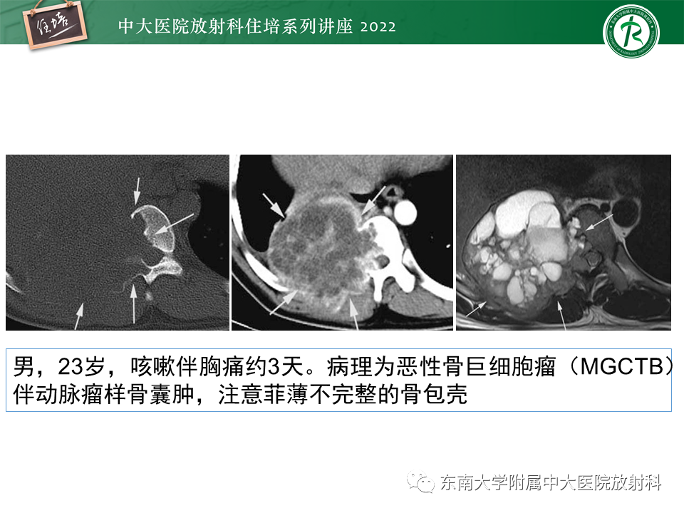 影像PPT - 【PPT】常见椎体孤立性肿瘤的诊断思路-20