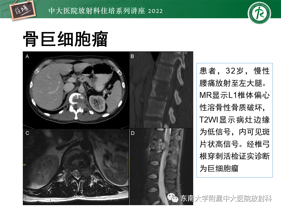 影像PPT - 【PPT】常见椎体孤立性肿瘤的诊断思路-17