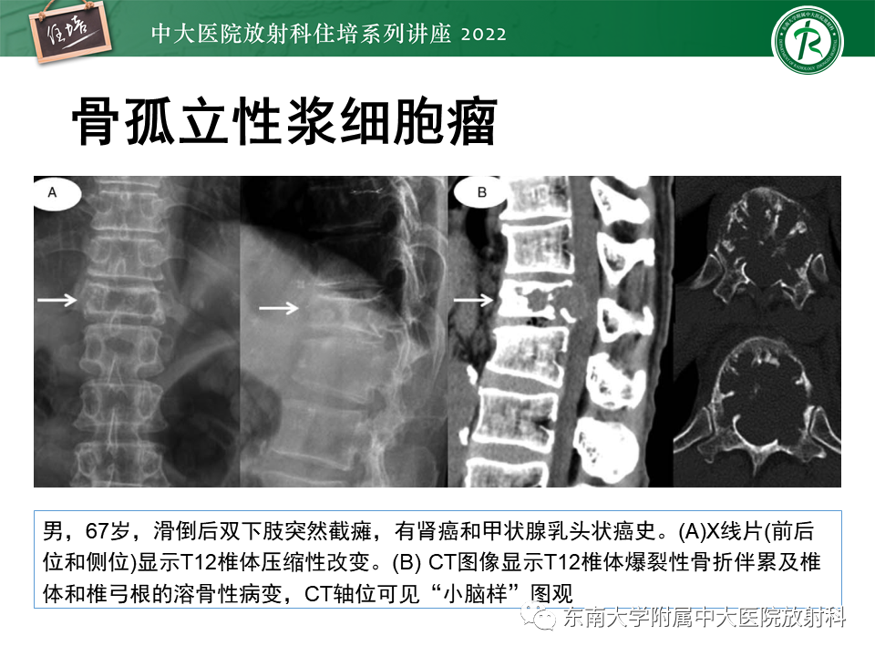 影像PPT - 【PPT】常见椎体孤立性肿瘤的诊断思路-28