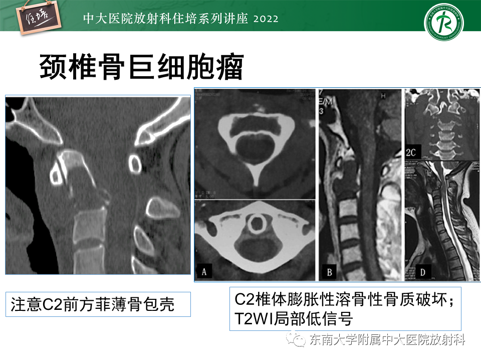 影像PPT - 【PPT】常见椎体孤立性肿瘤的诊断思路-19
