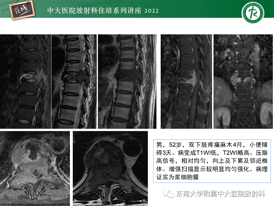 影像PPT - 【PPT】常见椎体孤立性肿瘤的诊断思路-25