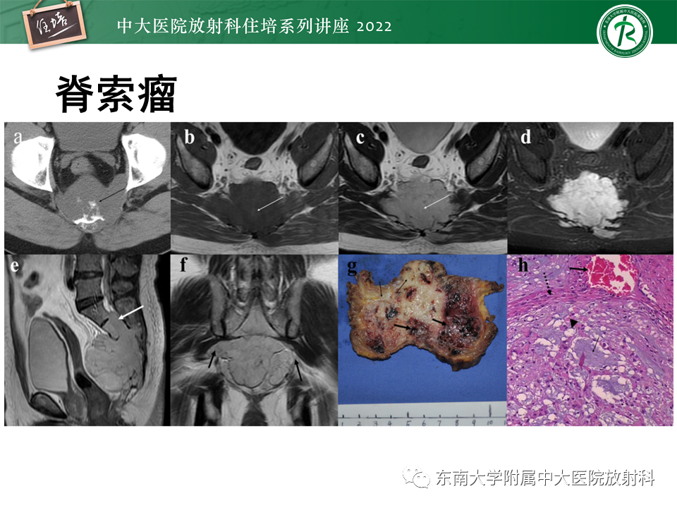 影像PPT - 【PPT】常见椎体孤立性肿瘤的诊断思路-22