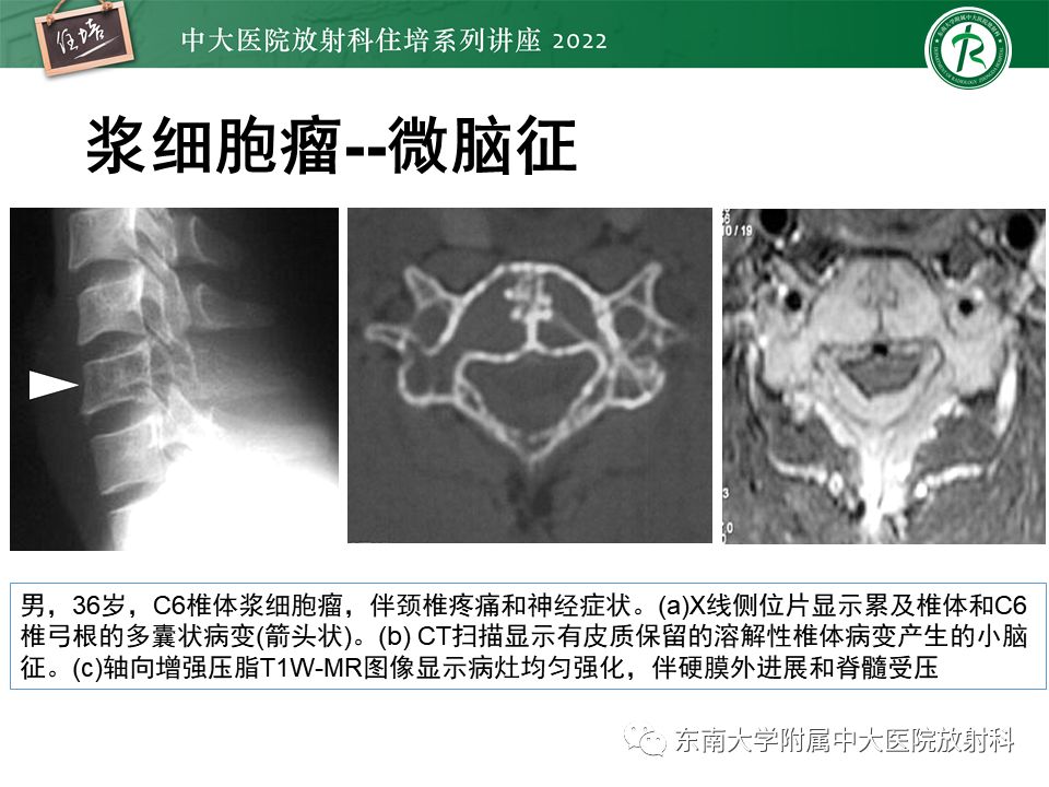 影像PPT - 【PPT】常见椎体孤立性肿瘤的诊断思路-27