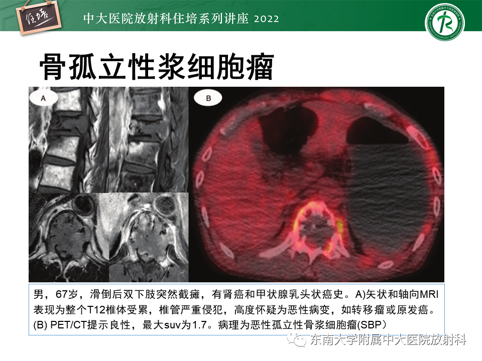 影像PPT - 【PPT】常见椎体孤立性肿瘤的诊断思路-29