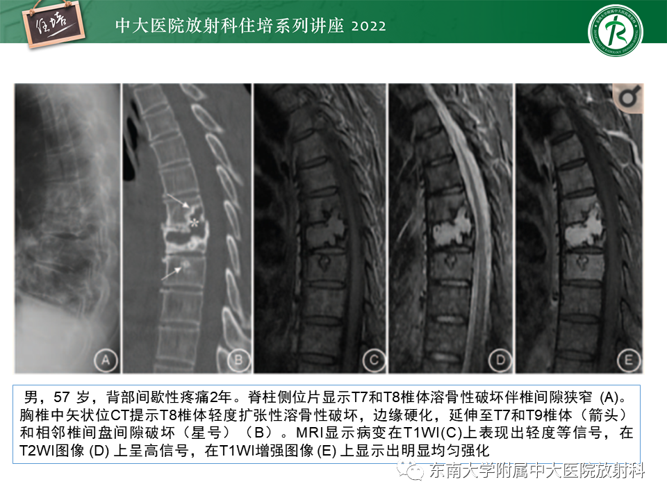 影像PPT - 【PPT】常见椎体孤立性肿瘤的诊断思路-30