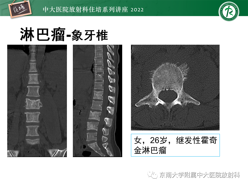影像PPT - 【PPT】常见椎体孤立性肿瘤的诊断思路-35