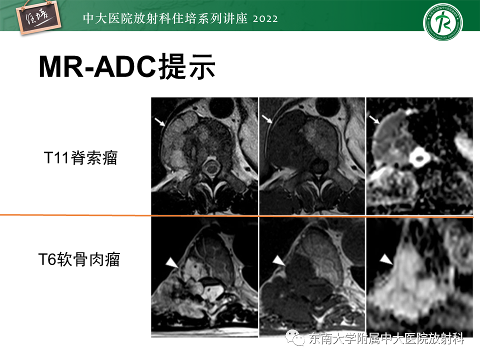 影像PPT - 【PPT】常见椎体孤立性肿瘤的诊断思路-41