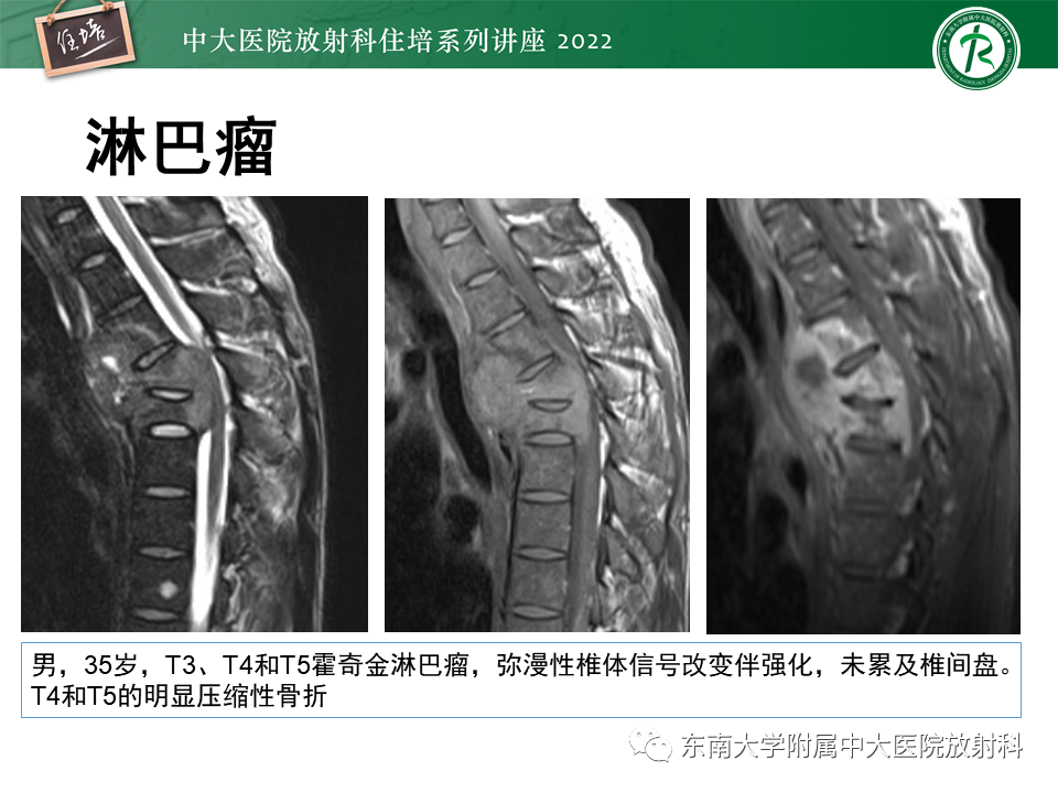影像PPT - 【PPT】常见椎体孤立性肿瘤的诊断思路-33