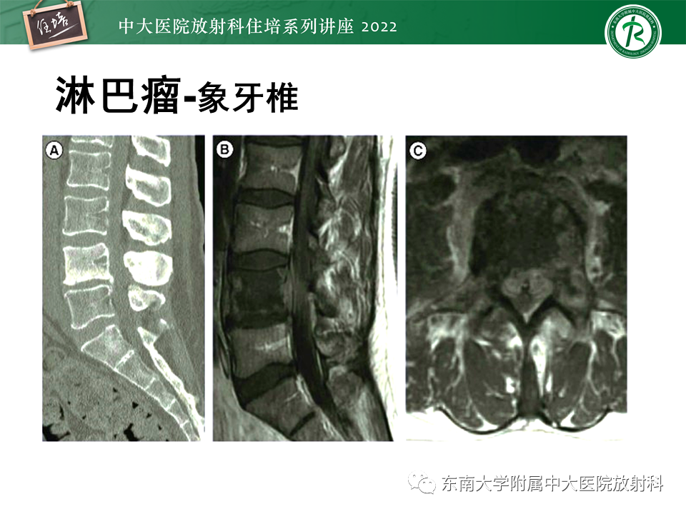 影像PPT - 【PPT】常见椎体孤立性肿瘤的诊断思路-34