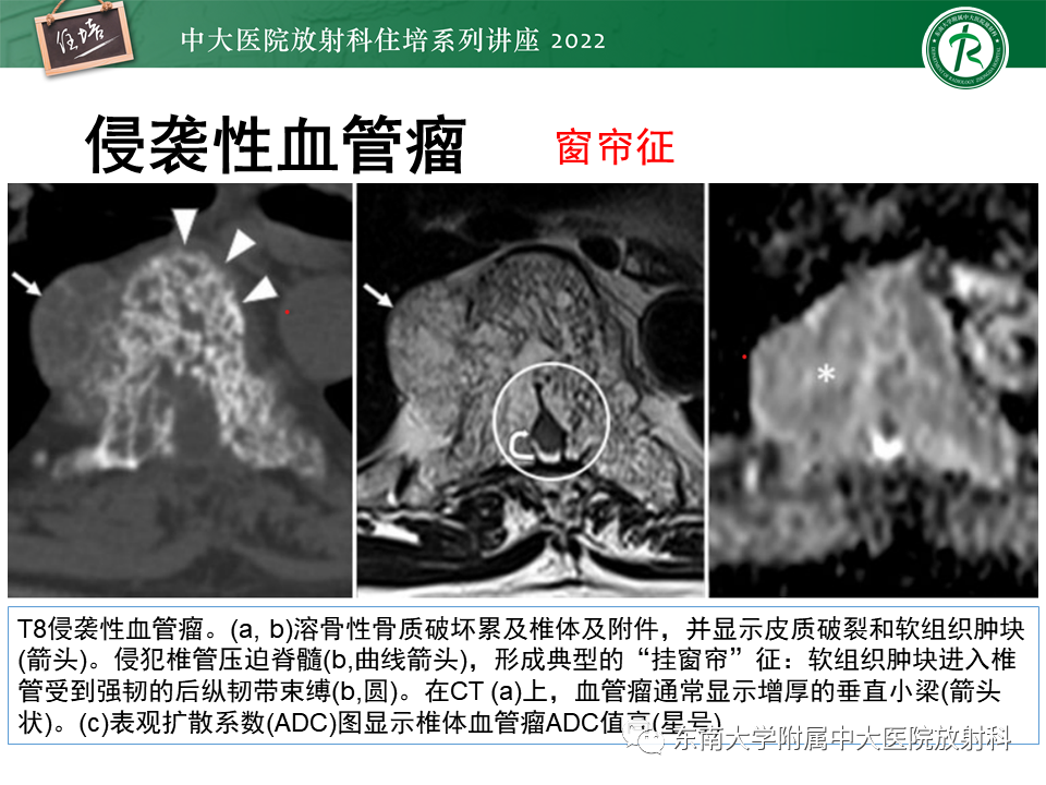 影像PPT - 【PPT】常见椎体孤立性肿瘤的诊断思路-8