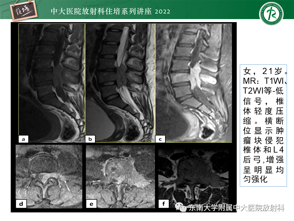 影像PPT - 【PPT】常见椎体孤立性肿瘤的诊断思路-31