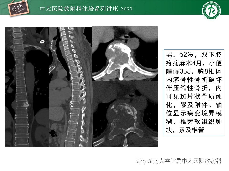 影像PPT - 【PPT】常见椎体孤立性肿瘤的诊断思路-24
