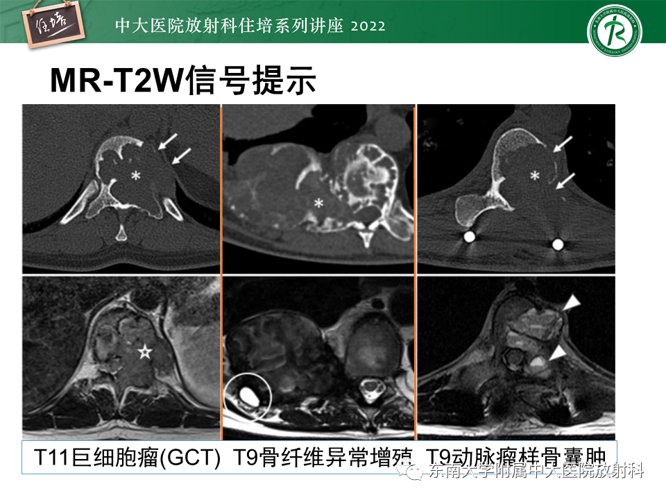 影像PPT - 【PPT】常见椎体孤立性肿瘤的诊断思路-40