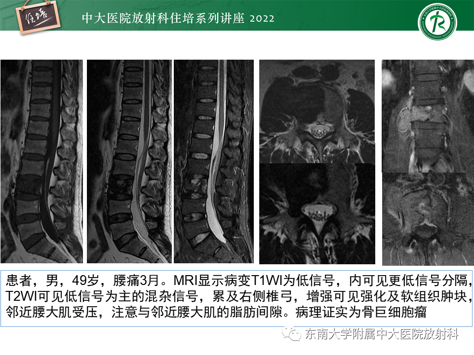 影像PPT - 【PPT】常见椎体孤立性肿瘤的诊断思路-2