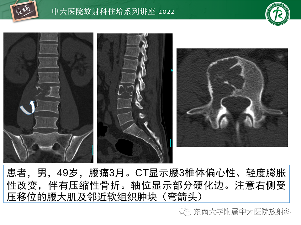 影像PPT - 【PPT】常见椎体孤立性肿瘤的诊断思路-1