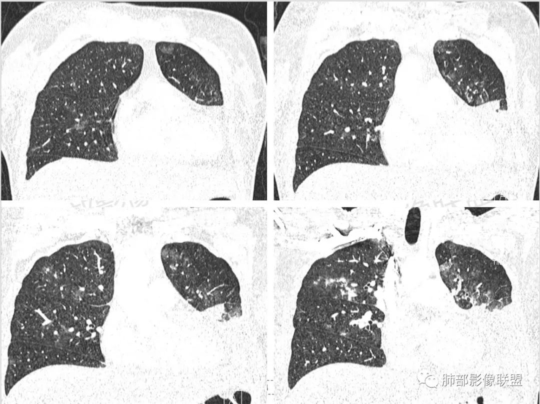 影像PPT - 【病例】肺部成这样，糖尿病惹的祸？-16