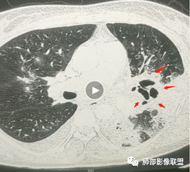 影像PPT - 【病例】肺部成这样，糖尿病惹的祸？-23