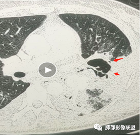 影像PPT - 【病例】肺部成这样，糖尿病惹的祸？-24