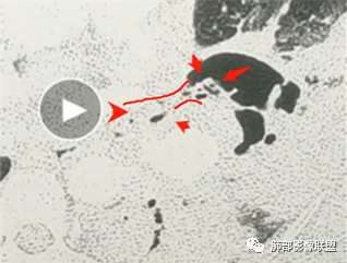 影像PPT - 【病例】肺部成这样，糖尿病惹的祸？-25