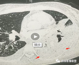 影像PPT - 【病例】肺部成这样，糖尿病惹的祸？-26