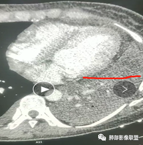影像PPT - 【病例】肺部成这样，糖尿病惹的祸？-28