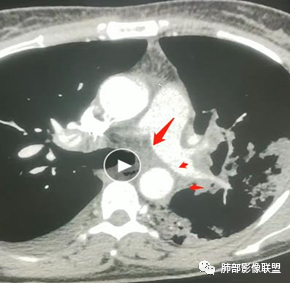 影像PPT - 【病例】肺部成这样，糖尿病惹的祸？-29