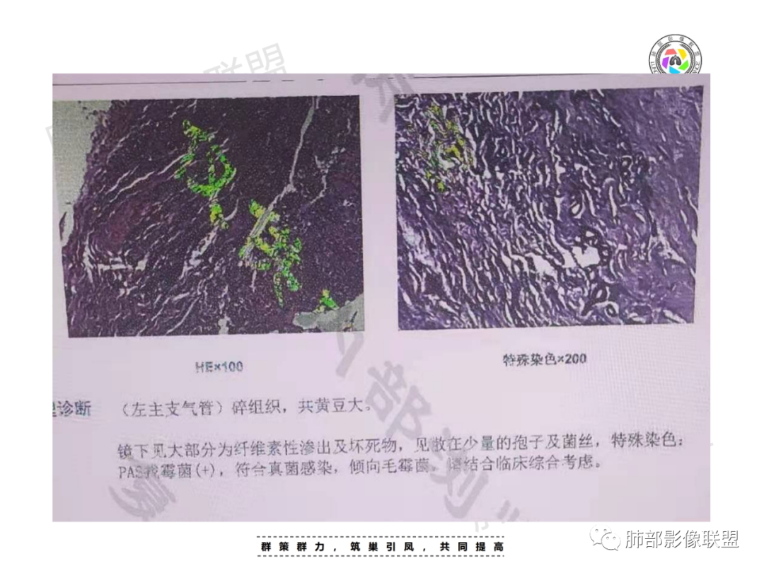 影像PPT - 【病例】肺部成这样，糖尿病惹的祸？-31