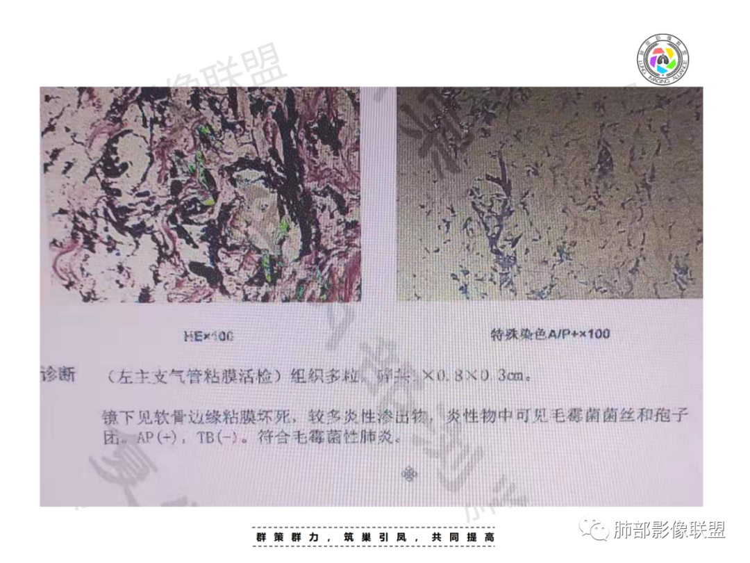 影像PPT - 【病例】肺部成这样，糖尿病惹的祸？-32