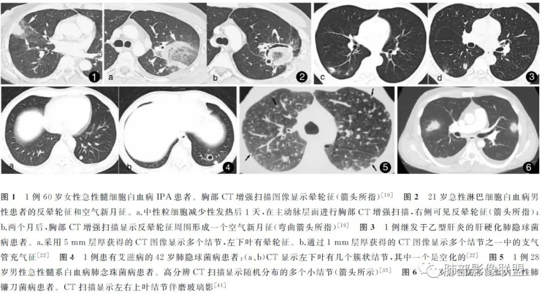 影像PPT - 【病例】肺部成这样，糖尿病惹的祸？-41