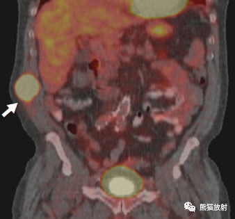 影像PPT - 骨外骨肉瘤影像表现-2 影像PPT - 骨外骨肉瘤影像表现-2