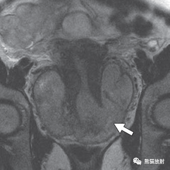 影像PPT - 骨外骨肉瘤影像表现-26 影像PPT - 骨外骨肉瘤影像表现-26