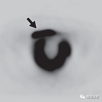 影像PPT - 骨外骨肉瘤影像表现-27 影像PPT - 骨外骨肉瘤影像表现-27