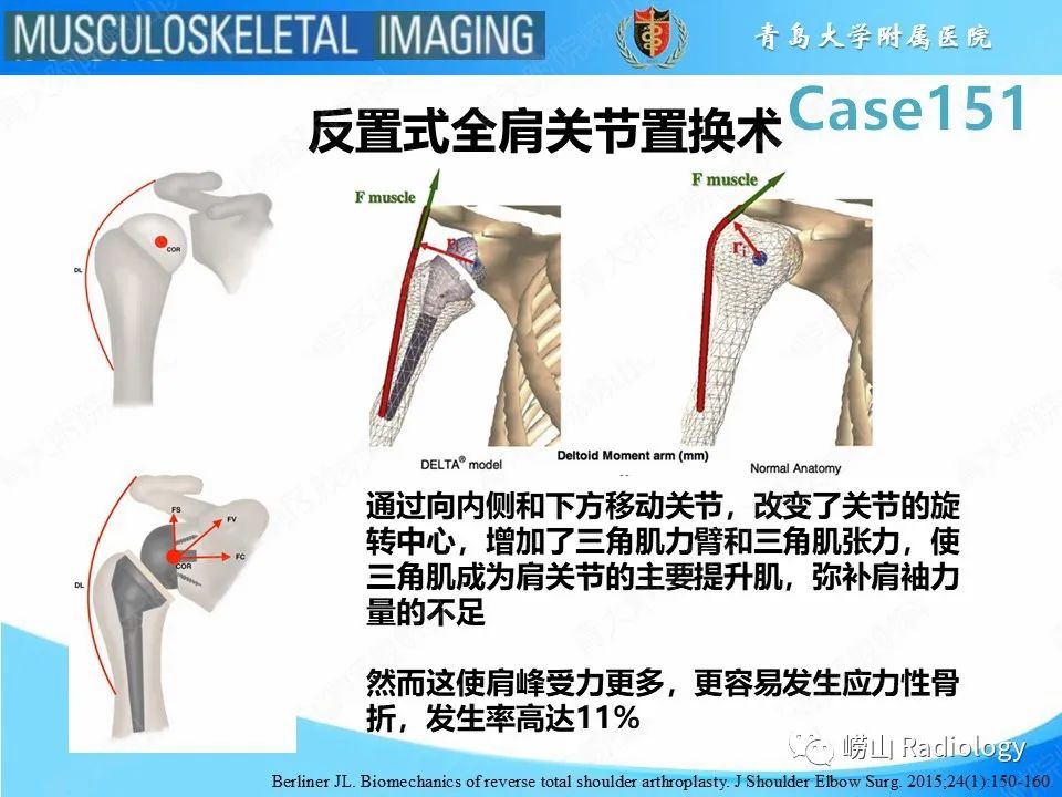 影像PPT - 【PPT】全肩关节置换术后肩峰骨折-10