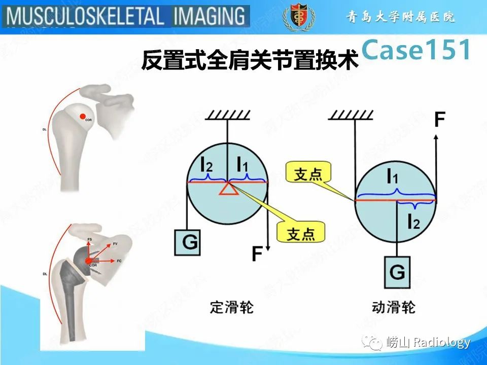 影像PPT - 【PPT】全肩关节置换术后肩峰骨折-11