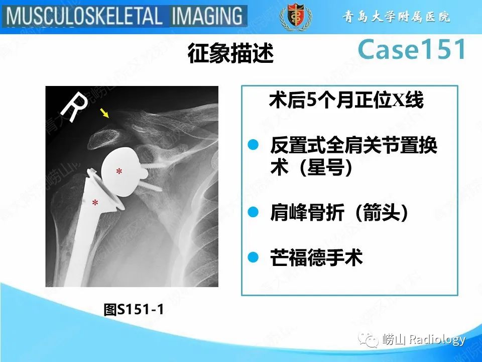 影像PPT - 【PPT】全肩关节置换术后肩峰骨折-15