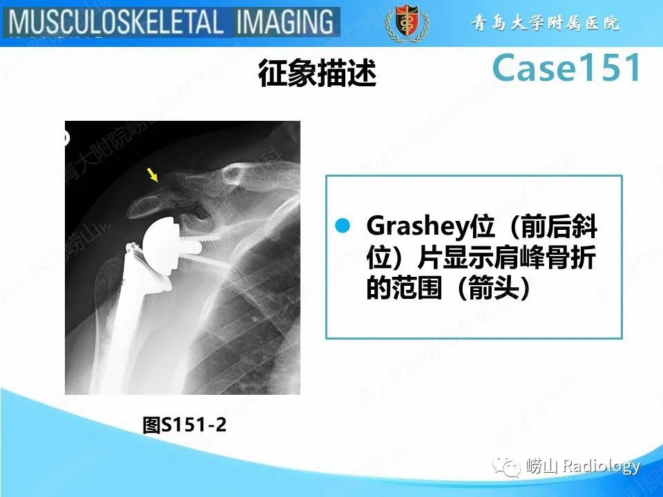 影像PPT - 【PPT】全肩关节置换术后肩峰骨折-16