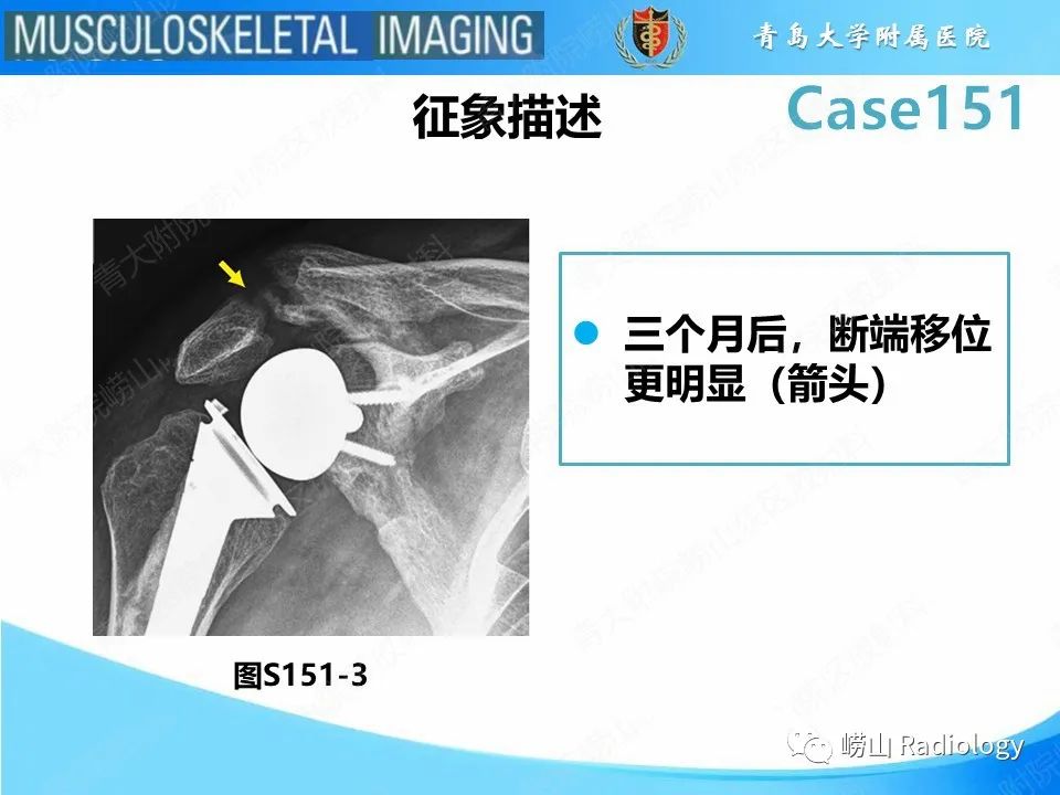 影像PPT - 【PPT】全肩关节置换术后肩峰骨折-17