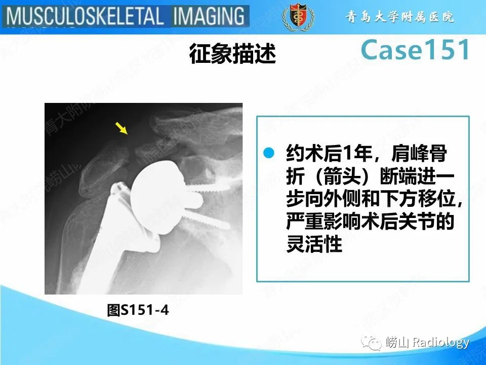 影像PPT - 【PPT】全肩关节置换术后肩峰骨折-18