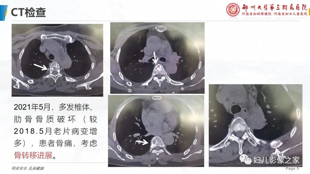 影像PPT - 【PPT】乳腺癌骨转移的假性进展-5